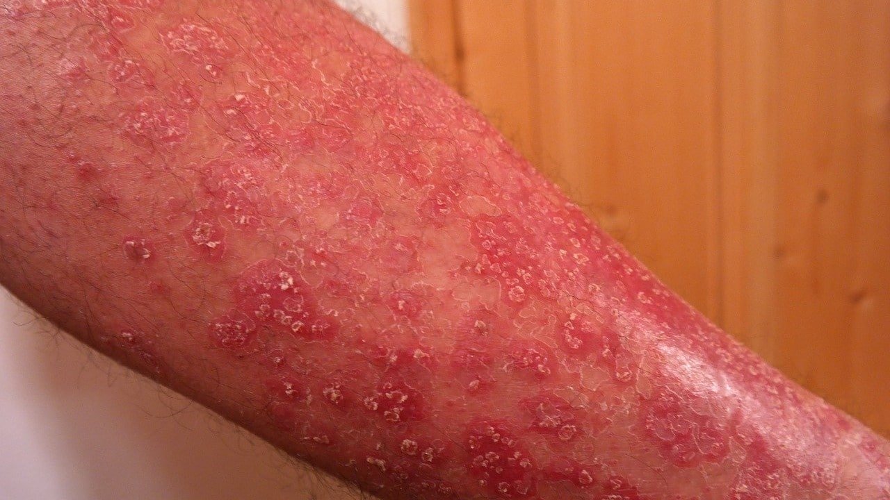 Schuppenflechte CBD Produkte