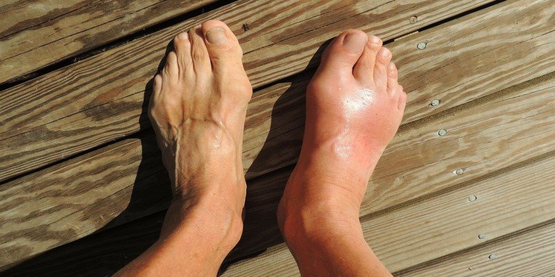 CBD-&Ouml;l Beschwerden Gicht